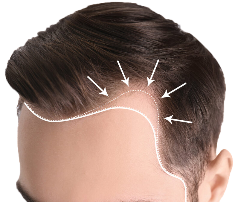 Hairline Redesigning – Hair Plasis